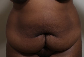 45-54 year old woman treated with Tummy Tuck before 3570361