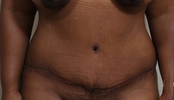45-54 year old woman treated with Tummy Tuck after 3570361