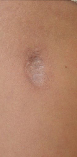 18-24 year old woman treated with Scars Treatment before 1556985