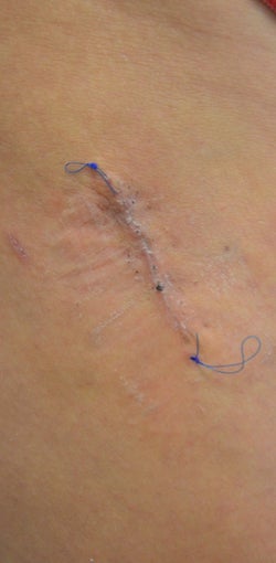 18-24 year old woman treated with Scars Treatment after 1556985