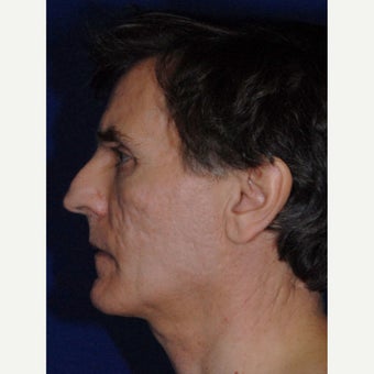 35-44 year old man treated with Bellafill before 2450436