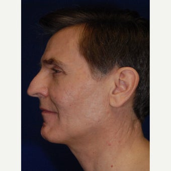 35-44 year old man treated with Bellafill after 2450436