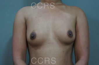 27 yr.old female (Transaxillary Videoendoscopic approach) before 1035096
