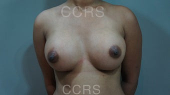 27 yr.old female (Transaxillary Videoendoscopic approach) after 1035096
