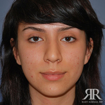 Rhinoplasty before 1315583