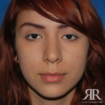 Rhinoplasty after 1315583