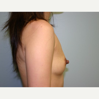 Breast Augmentation before 3560697
