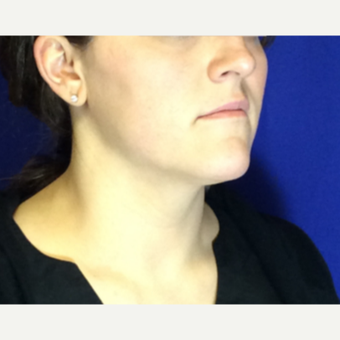 25-34 year old woman treated with Ultherapy Lower Face after 3185690