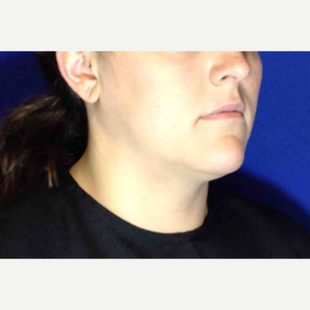 25-34 year old woman treated with Ultherapy Lower Face before 3185690