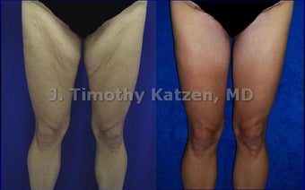 Thigh Lift after massive weight loss before 667176