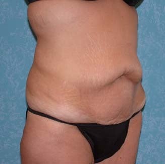 Circumferential Body Lift with Buttock Augmentation before 857483