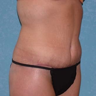Circumferential Body Lift with Buttock Augmentation after 857483
