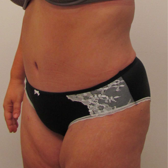 Tummy Tuck for This 42 Year Old Woman after 3181969