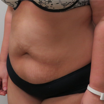 Tummy Tuck for This 42 Year Old Woman before 3181969