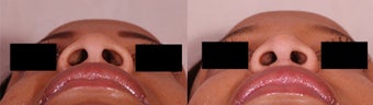 Rhinoplasty before 677281