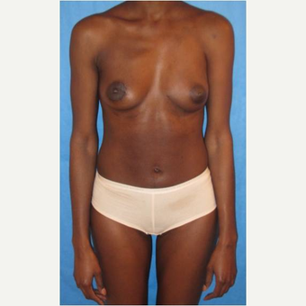 30 year old woman treated with PAP flap Breast Reconstruction after 3725386