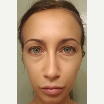 29 year old female, with under eye bags and dark circles, underwent lower blepharoplasty. before 3693667