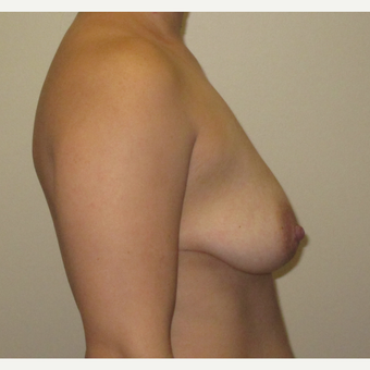 25-34 year old woman treated with Breast Implants before 3423757