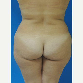 45-54 year old woman treated with Brazilian Butt Lift before 3107901