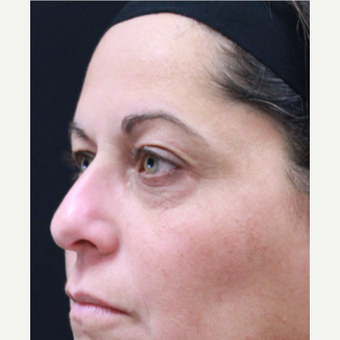 51 year old female treated with Botox for crow's feet and eyebrow raise before 3418038