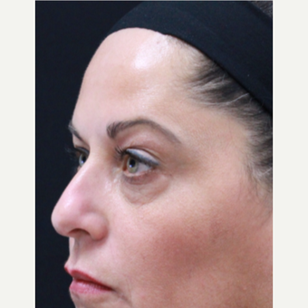 51 year old female treated with Botox for crow's feet and eyebrow raise after 3418038