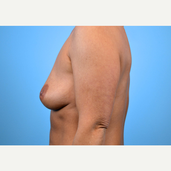 35-44 year old woman treated with Breast Implants before 3440937
