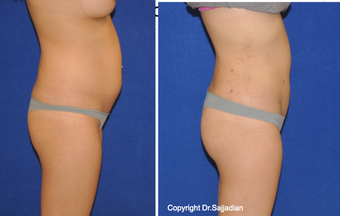 Butt Augmentation before 1262616