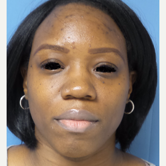 35-44 year old woman treated with African American Rhinoplasty before 3169259