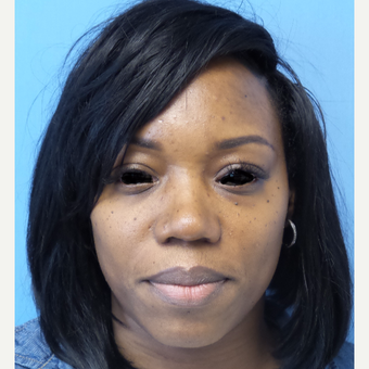 35-44 year old woman treated with African American Rhinoplasty after 3169259
