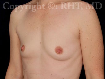 Breast enlargement before 259388