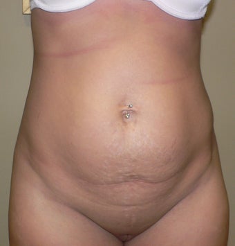 36 year old woman has Tummy Tuck before 990643