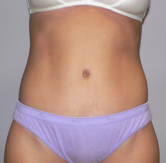 36 year old woman has Tummy Tuck after 990643