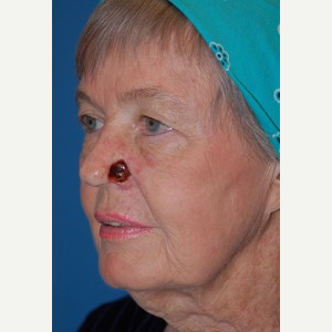 55-64 year old woman treated with Mohs Surgery before 3389230