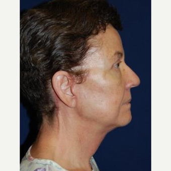 55-64 year old woman treated with Facelift after 3370674