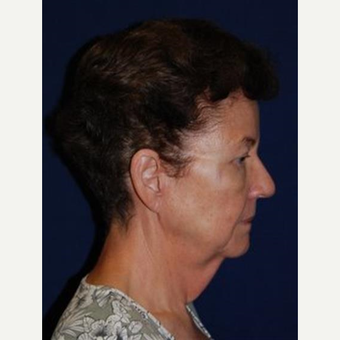 55-64 year old woman treated with Facelift before 3370674