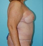 Bilateral DIEP Flap Breast Reconstruction: Delayed 1074123