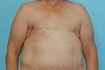 Bilateral DIEP Flap Breast Reconstruction: Delayed before 1074123
