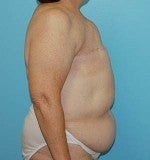 Bilateral DIEP Flap Breast Reconstruction: Delayed 1074123