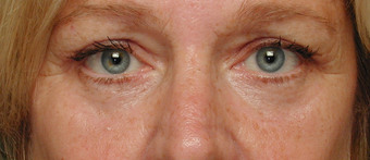 Laser resurfacing, Blepharoplasty after 332427