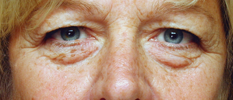 Laser resurfacing, Blepharoplasty before 332427