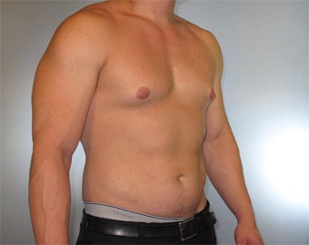 30-year-old Male Gynecomastia 1469758