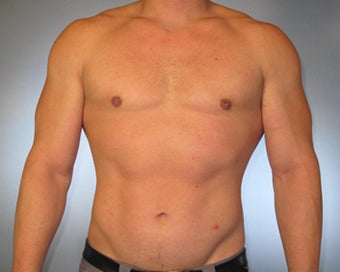 30-year-old Male Gynecomastia after 1469758