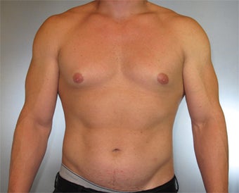 30-year-old Male Gynecomastia before 1469758