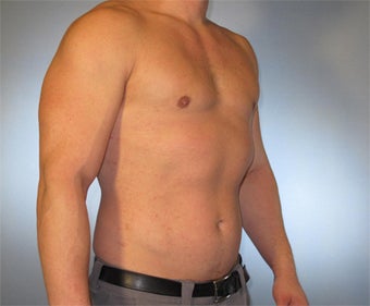 30-year-old Male Gynecomastia 1469758