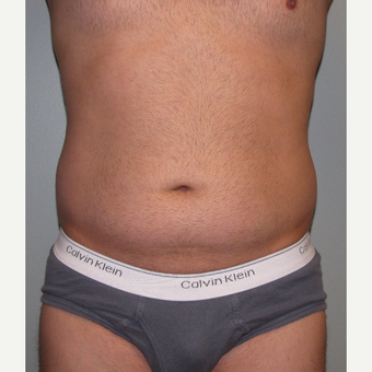 35-44 year old man treated with Liposuction before 3248797
