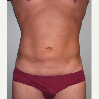 35-44 year old man treated with Liposuction after 3248797