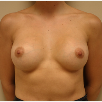 25-34 year old woman treated with Breast Augmentation after 3037817