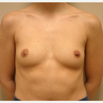 25-34 year old woman treated with Breast Augmentation before 3037817