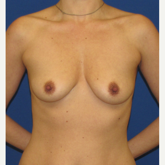 25-34 year old woman treated with Breast Implants before 3847370