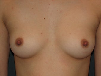 Breast Augmentation before 122650